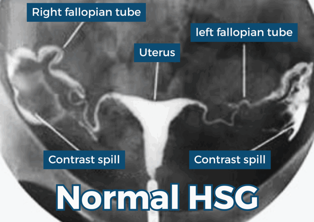 HSG