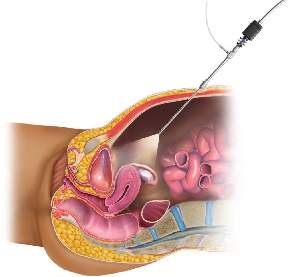Laparoscopy