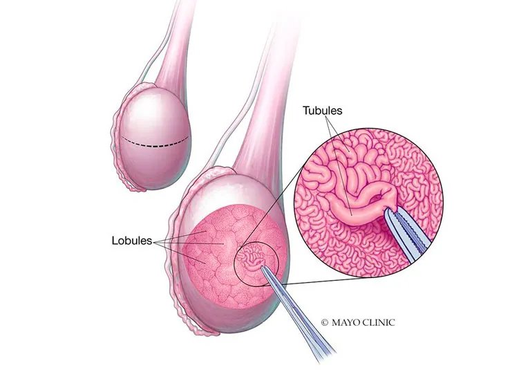 Sperm Extraction